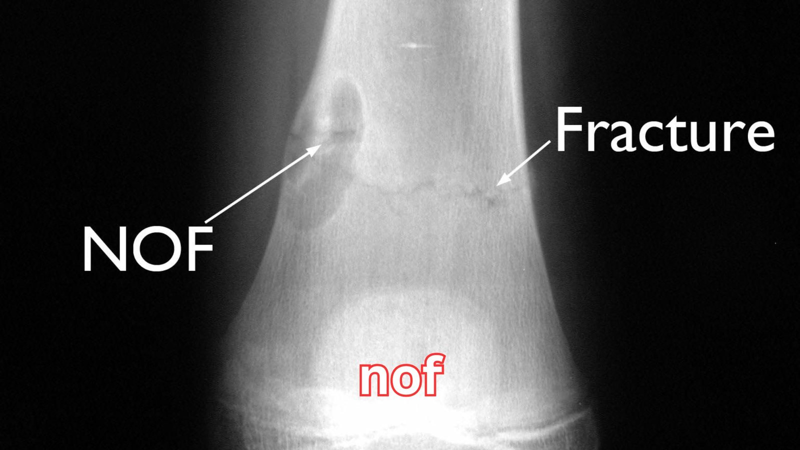 nof: The Powerful Truth Behind This Controversial Online Term